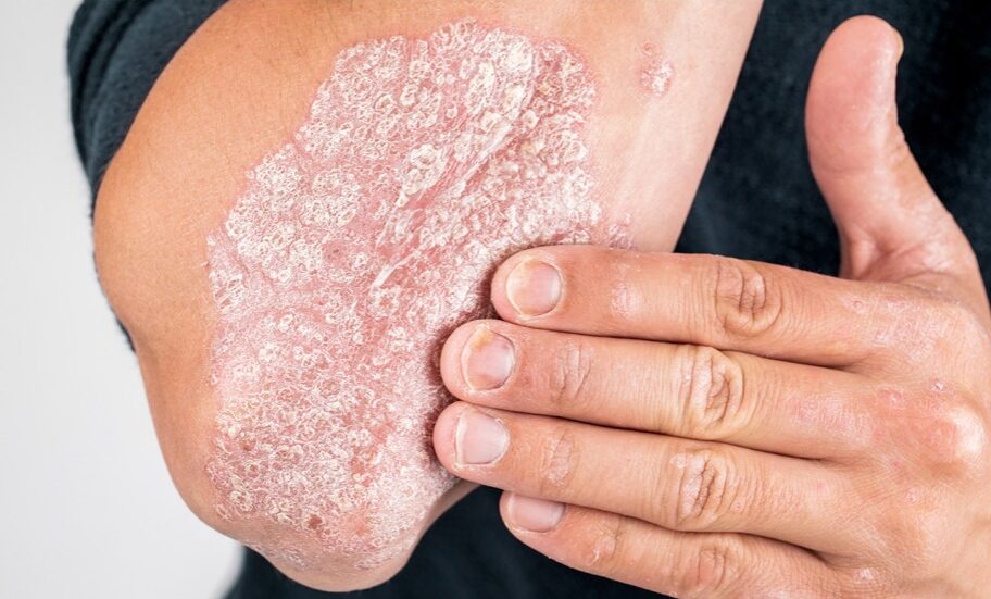 الصدفية مرض جلدي مزمن له 7 أنواع؛ تعال نعرفك عليها