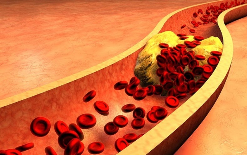 تطوير برنامج للفحص ما قبل الزواج وفحص حديثي الولادة لفرط كوليسترول الدم العائلي