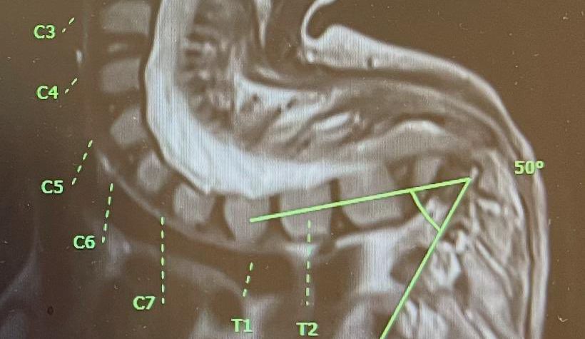 فريق طبي ينجح في إجراء جراحة متقدمة لطفلة تعاني من شلل الأطراف السفلية