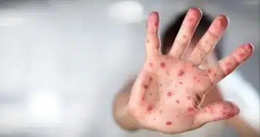 الصحة تُعلّق حول مستجدات جدري القردة