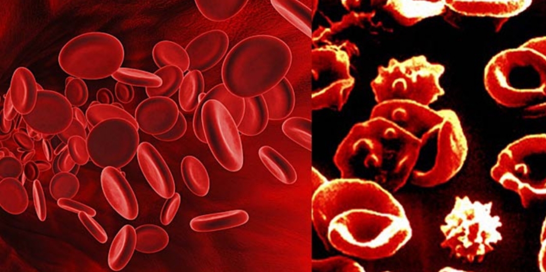 أخصائية تكشف عدد المصابين بالثلاسيميا في السلطنة…واختصاصية توضح أهمية الفحص قبل الزواج