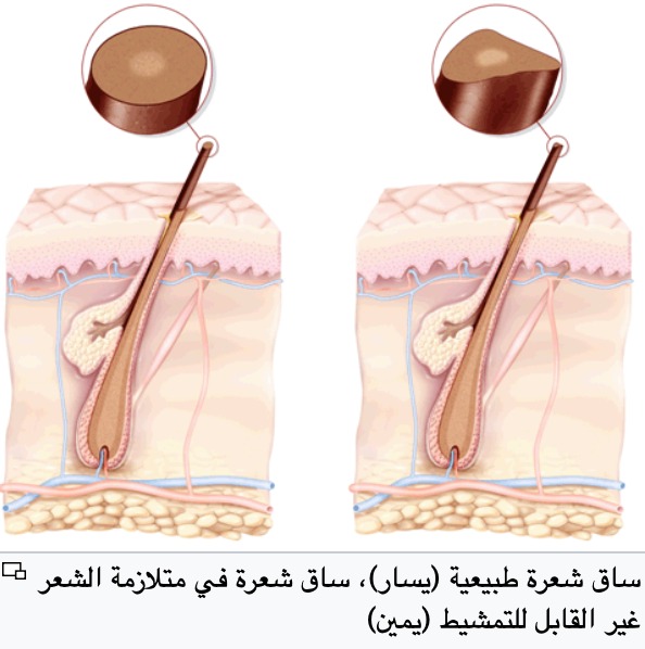 تعد حالة غريبة ونادرة: ماذا تعرف عن متلازمة الشعر غير القابل للتمشيط؟