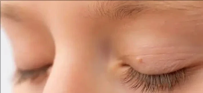 لماذا عليك عدم إهمال الزوائد الجلدية حول عينيك؟