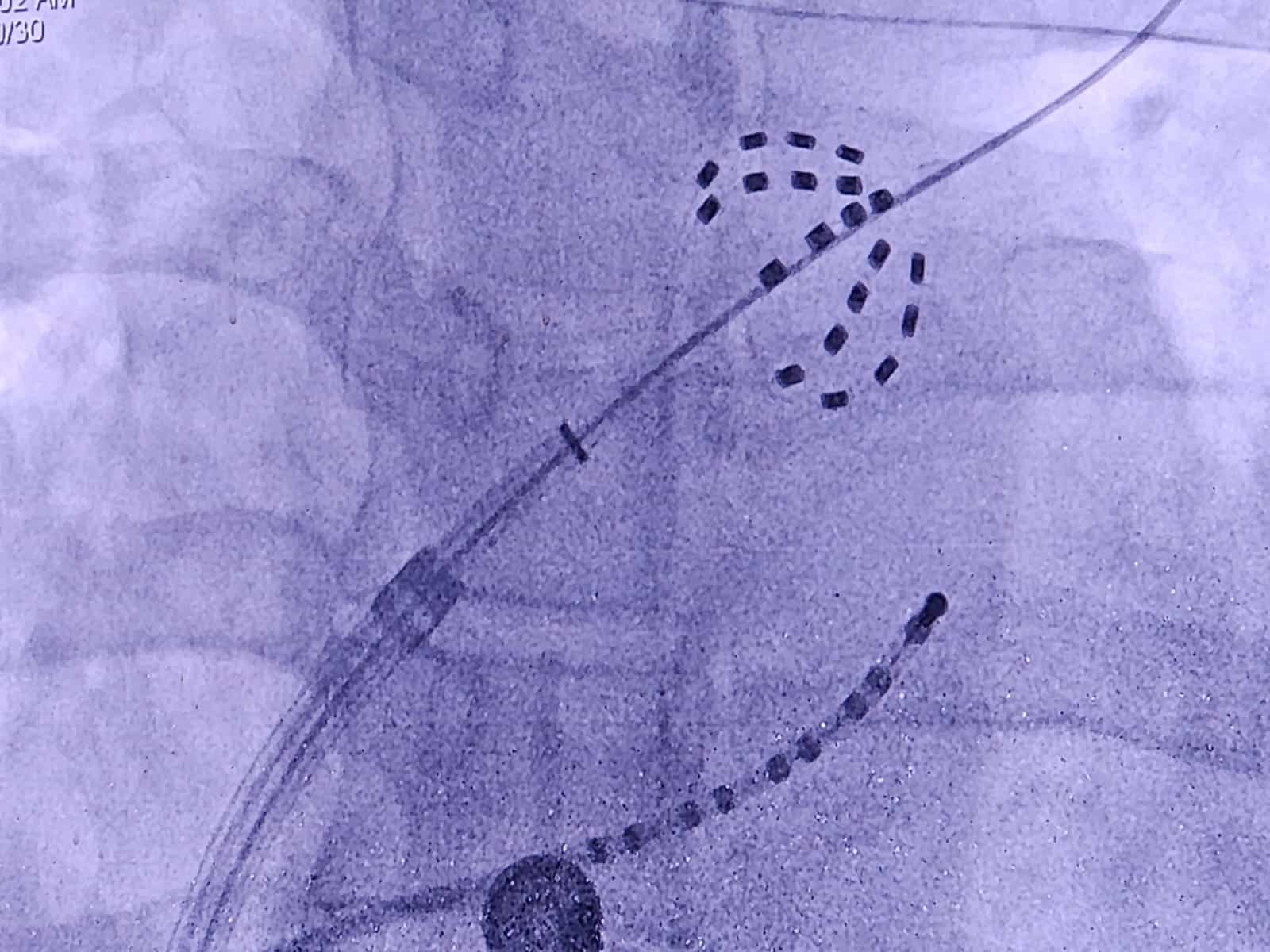 ما التقنية العالمية التي دشّنها المستشفى السلطاني مؤخرًا؟