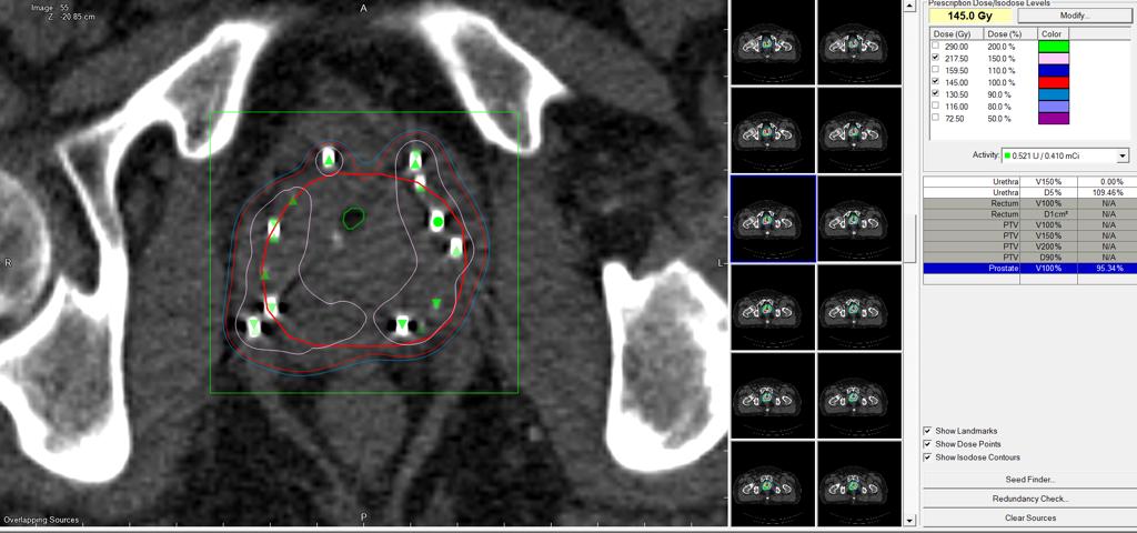 إجراء عملية الأولى من نوعها في مركز السُّلطان قابوس المتكامل لعلاج وبحوث أمراض السرطان