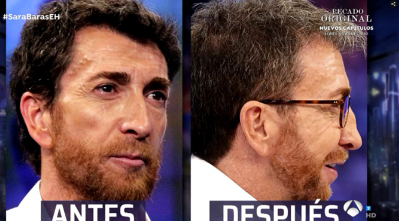 Nariz Rota Antes Y Despues Postoperatorio De La Cirugía De La Nariz