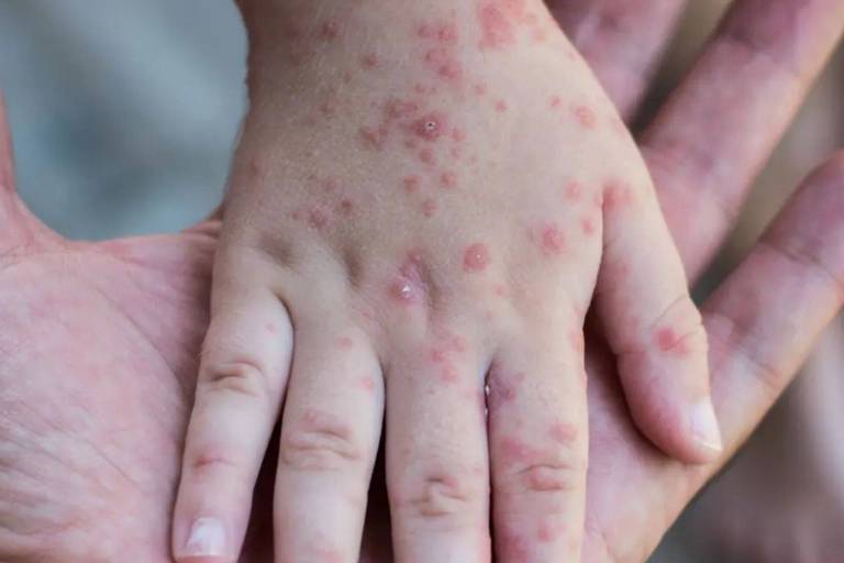 La variole du singe : toute l'actu, les symptômes, les traitements ...