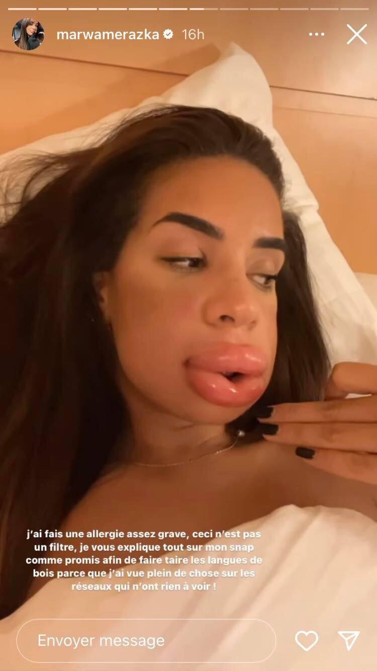 Marwa Les Apprentis Aventuriers Chirurgie Mon visage est déformé" : défigurée après une injection, une candidate de  télé-réalité dévoile des images chocs - La DH/Les Sports+