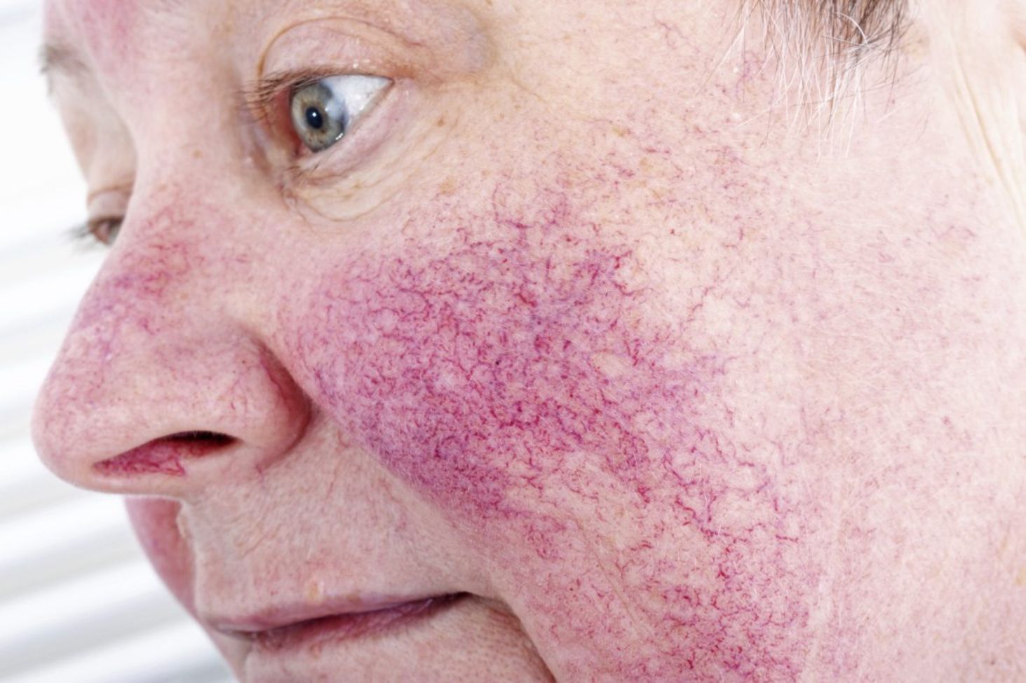Blister Rash On Face Adult