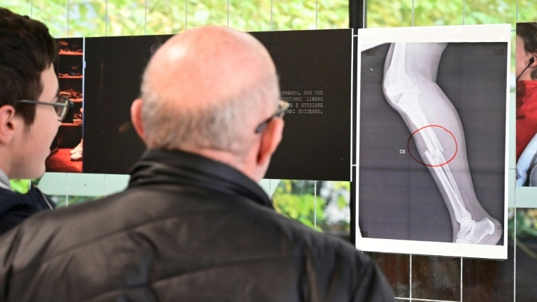 Visiteurs de l'exposition devant une radiographie montrant une fracture tibia péroné.
