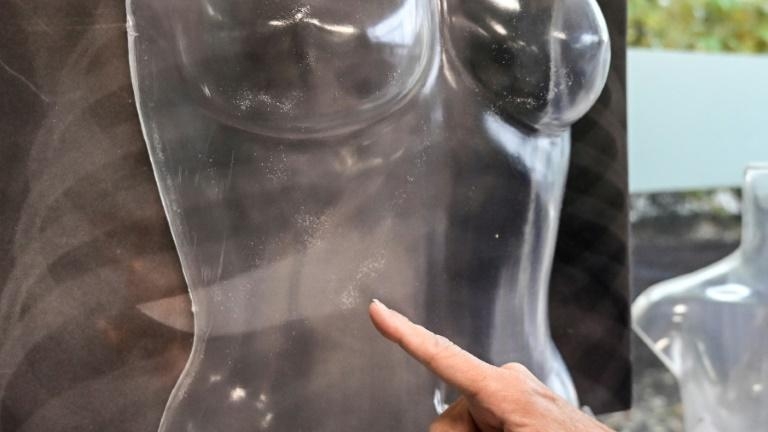 Radiographie d'un couteau de boucher enfoncé dans la cage thoracique d'une femme lors de l'exposition sur les violences faites aux femmes à l'hôpital San Carlo de Milan, le 22 novembre 2019
