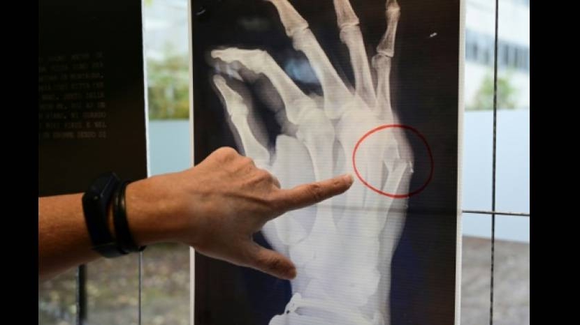 Un médecin montre les os fracturés sur une radiographie lors de l'exposition sur les violences faites aux femmes à l'hôpital San Carlo de Milan, le 22 novembre 2019.
