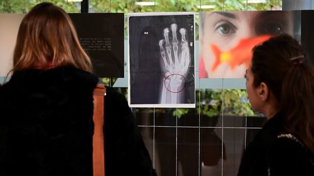 Des visiteuses de l'exposition devant une radiographie montrant une fracture du poignet.
