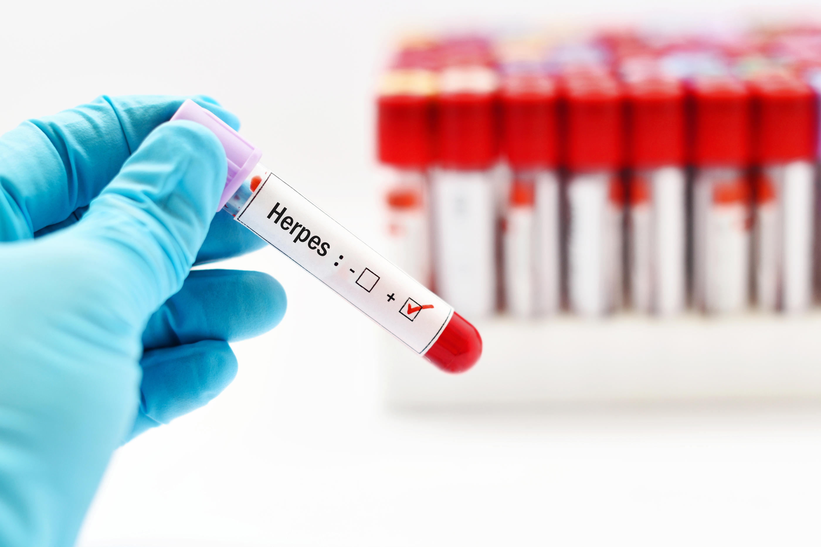 Le diagnostic de l’herpès génital repose sur un test PCR effectué sur un prélèvement au niveau des lésions. Istock/jarun011