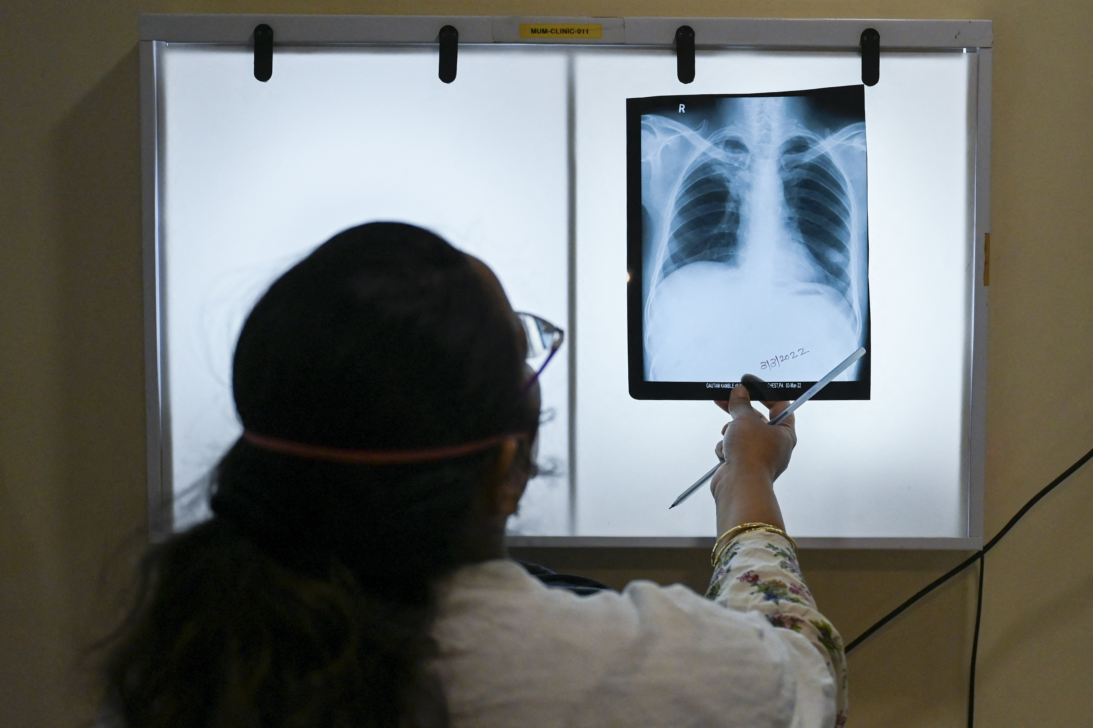 La tuberculose est toujours présente en France, avec 4217 cas détectés en 2022 (Illustration). AFP/Punit Paranjpe