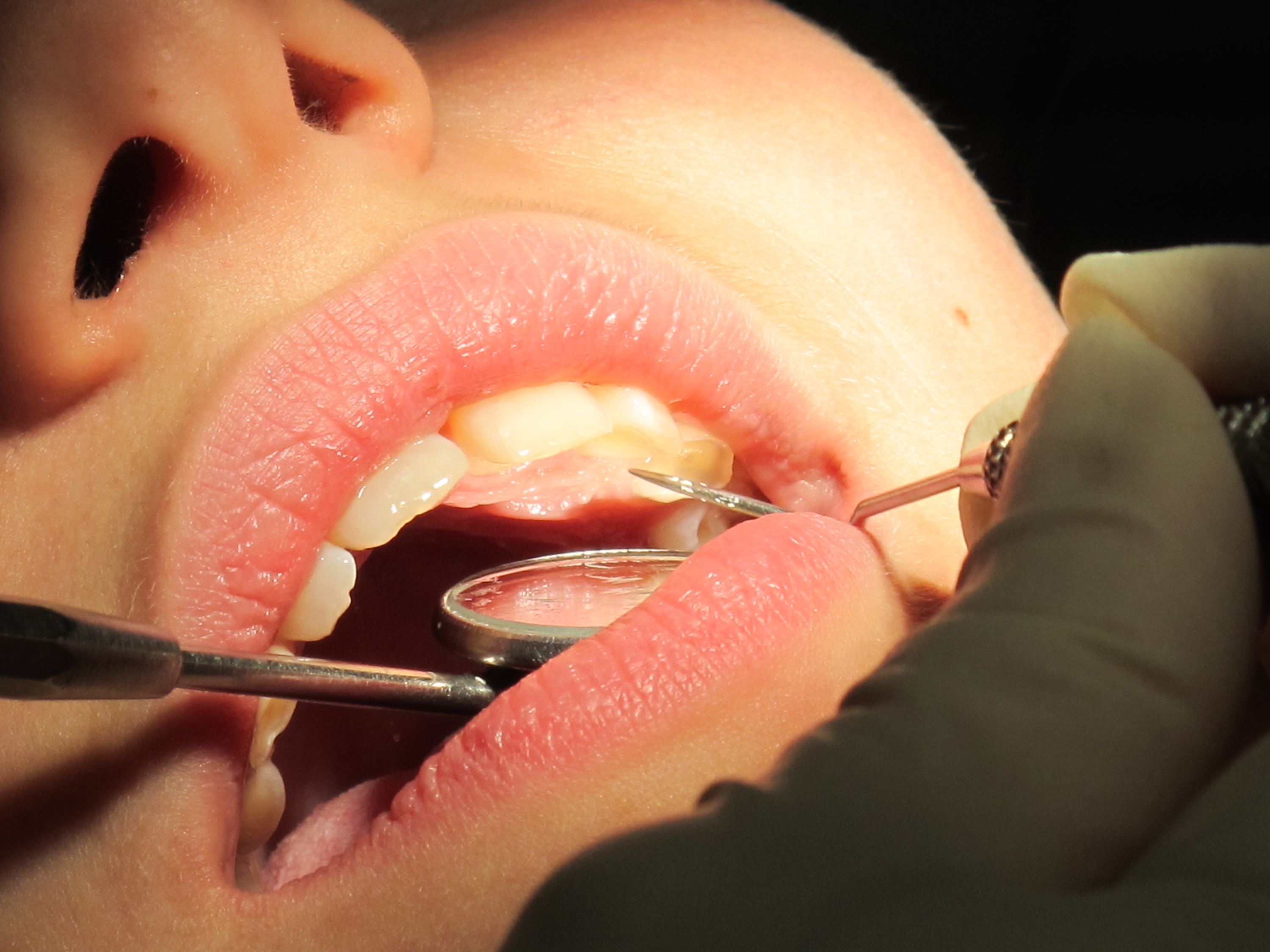 Dentiste Enlever Les Bandes De Caoutchouc Des Accolades Du Patient. Photo  stock - Image du bouche, dentaire: 229553298