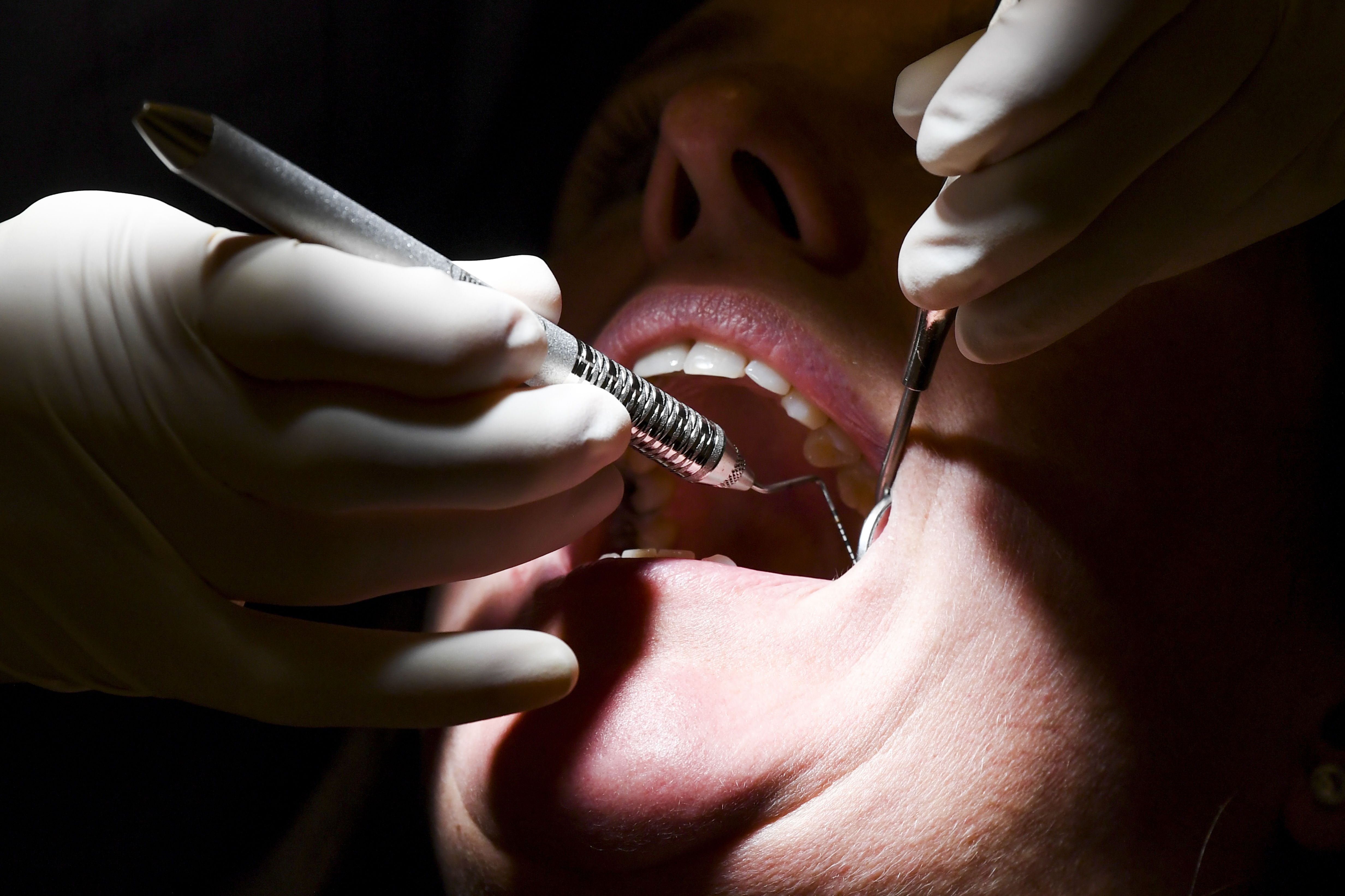 Aux Etats-Unis, plus de 70 % des praticiens sondés ont remarqué une augmentation du nombre de patients souffrant de grincements et de serrements de dents. (Illustration.)
