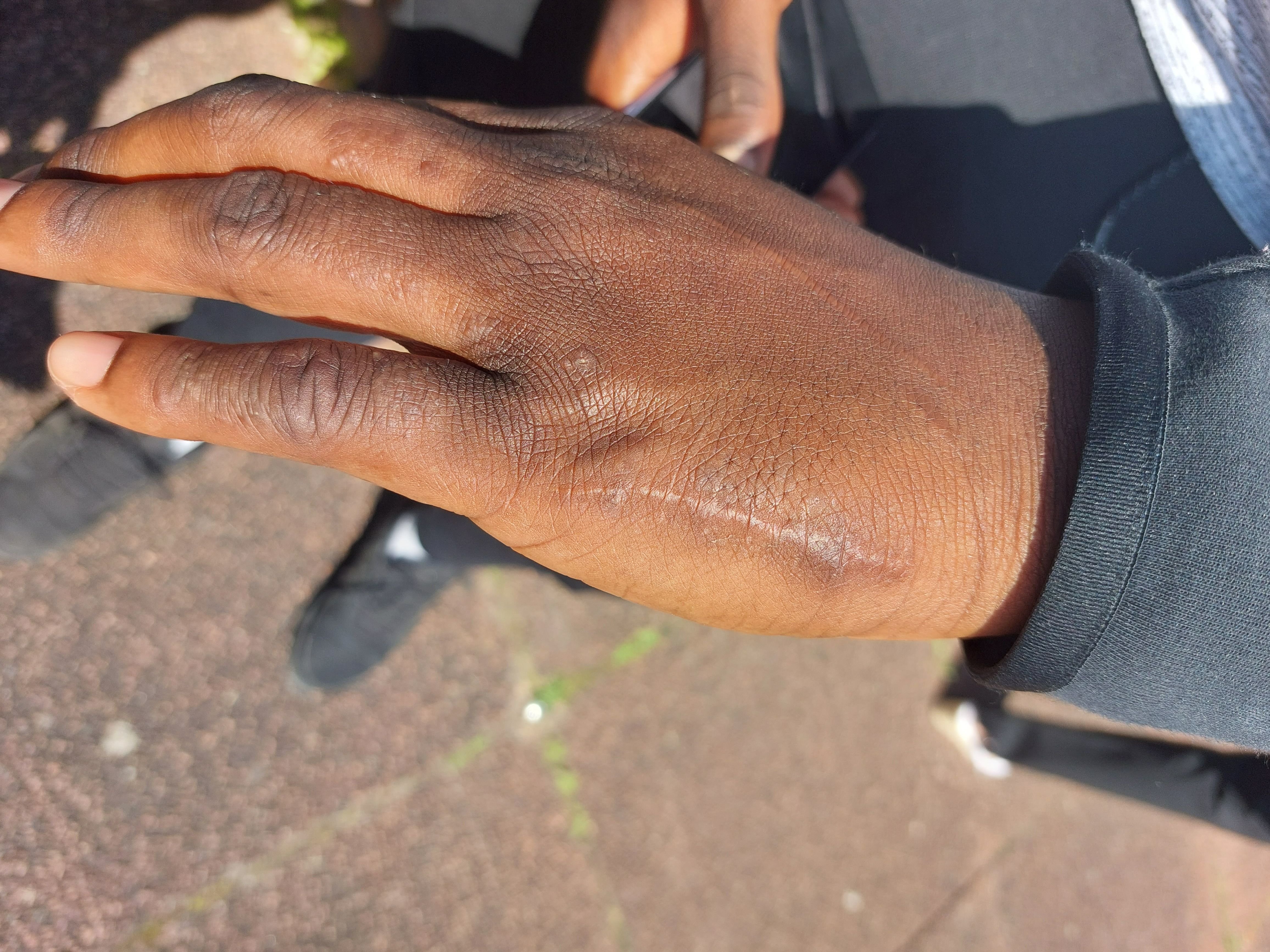 Mamby, désormais âgé de 20 ans, avait eu la main cassée après des coups de matraque portés par un policier de la brigade territoriale de contact (BTC) il y a trois ans. /DR