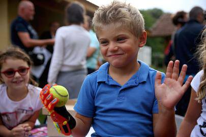 Des mains imprimées en 3D pour des enfants nés avec une malformation