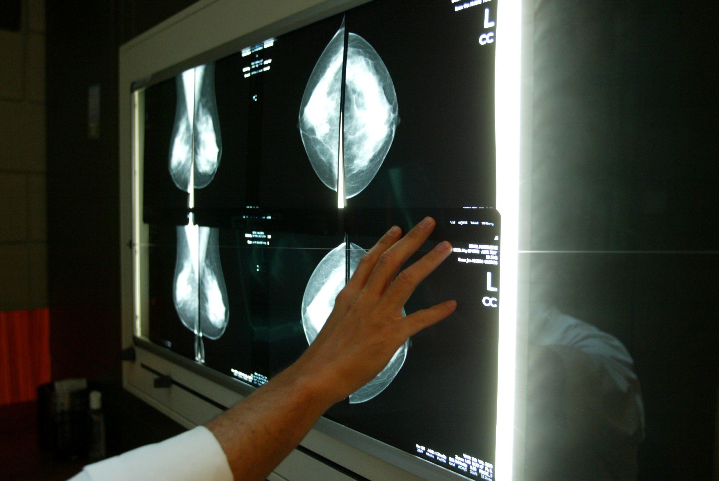 Face au cancer du sein, les Françaises de 50 à 74 ans se voient proposer, tous les deux ans, un examen clinique des seins et une mammographie. LP/Aurélie Audureau