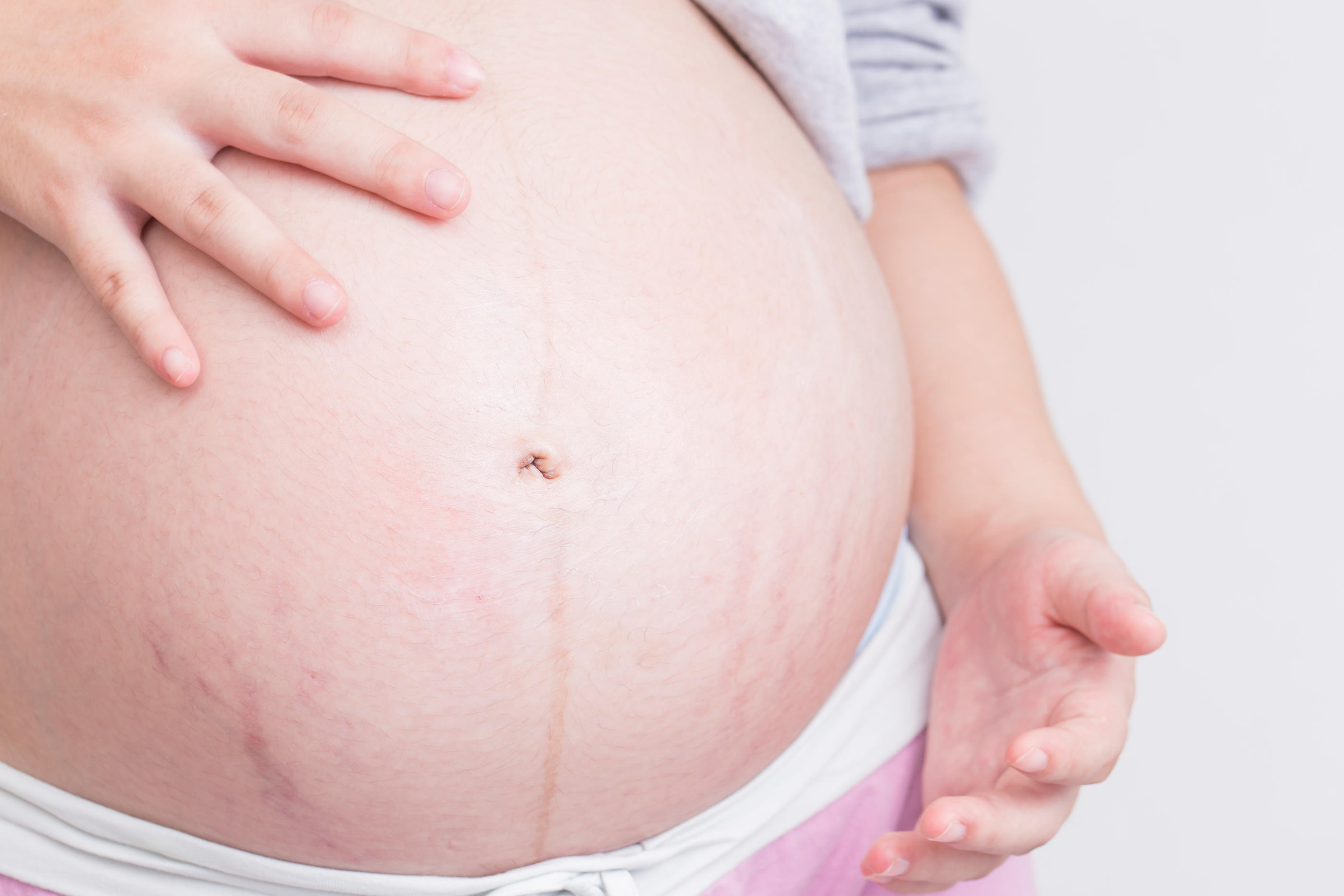 Les traitements contre les vergetures, qui apparaissent souvent lors d'une grossesse, sont actuellement encore trop peu satisfaisants. IStock