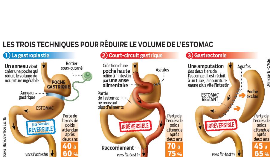 Sleeve gastrectomie, traitement chirurgical de l'obésité à Paris