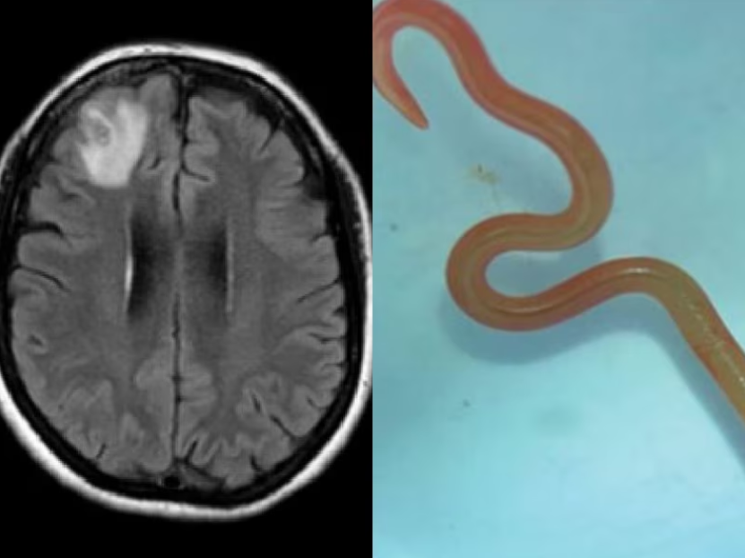 Le ver rond, long de 8 centimètres, a été détecté lors d'une IRM du cerveau. CR : Emerging Infectious Diseases
