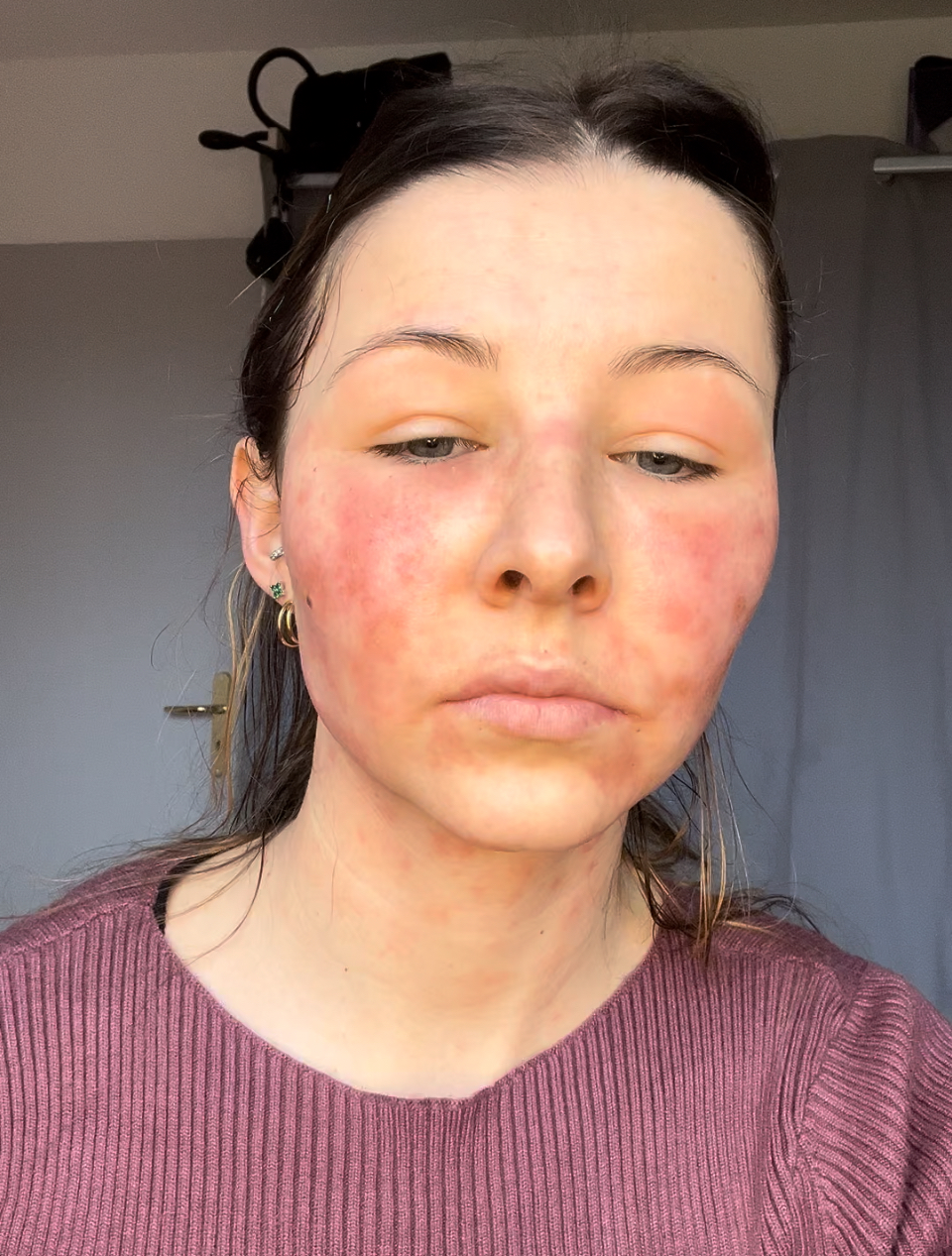 La créatrice de contenu Emma Artwest affirme avoir été brûlée après avoir utilisé des produits cosmétiques. /Emma Artwest