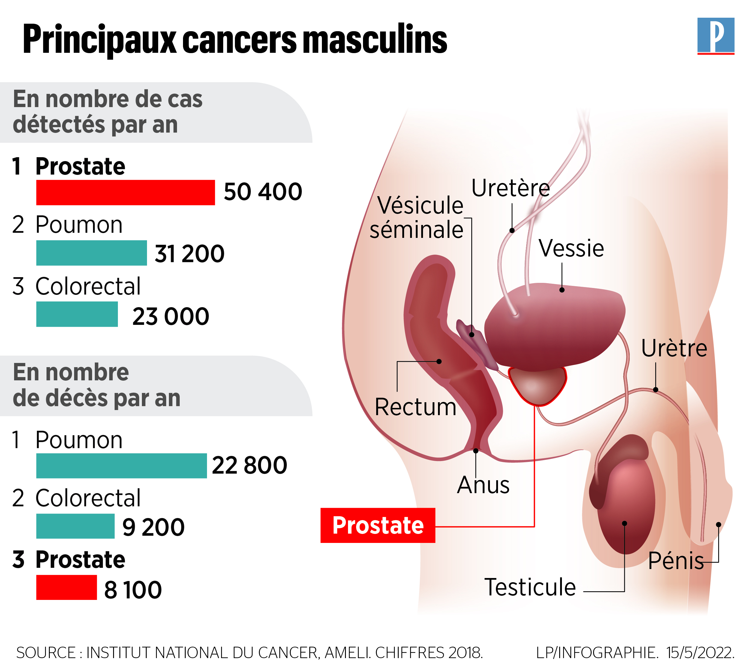 Cancer de la prostate : quand faut-il le dépister ? - Le Parisien