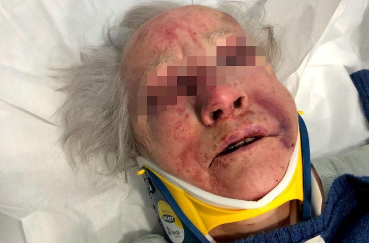 <b></b> Agnès, 85 ans, souffrait d’un traumatisme crânien et d’une double fracture du nez.