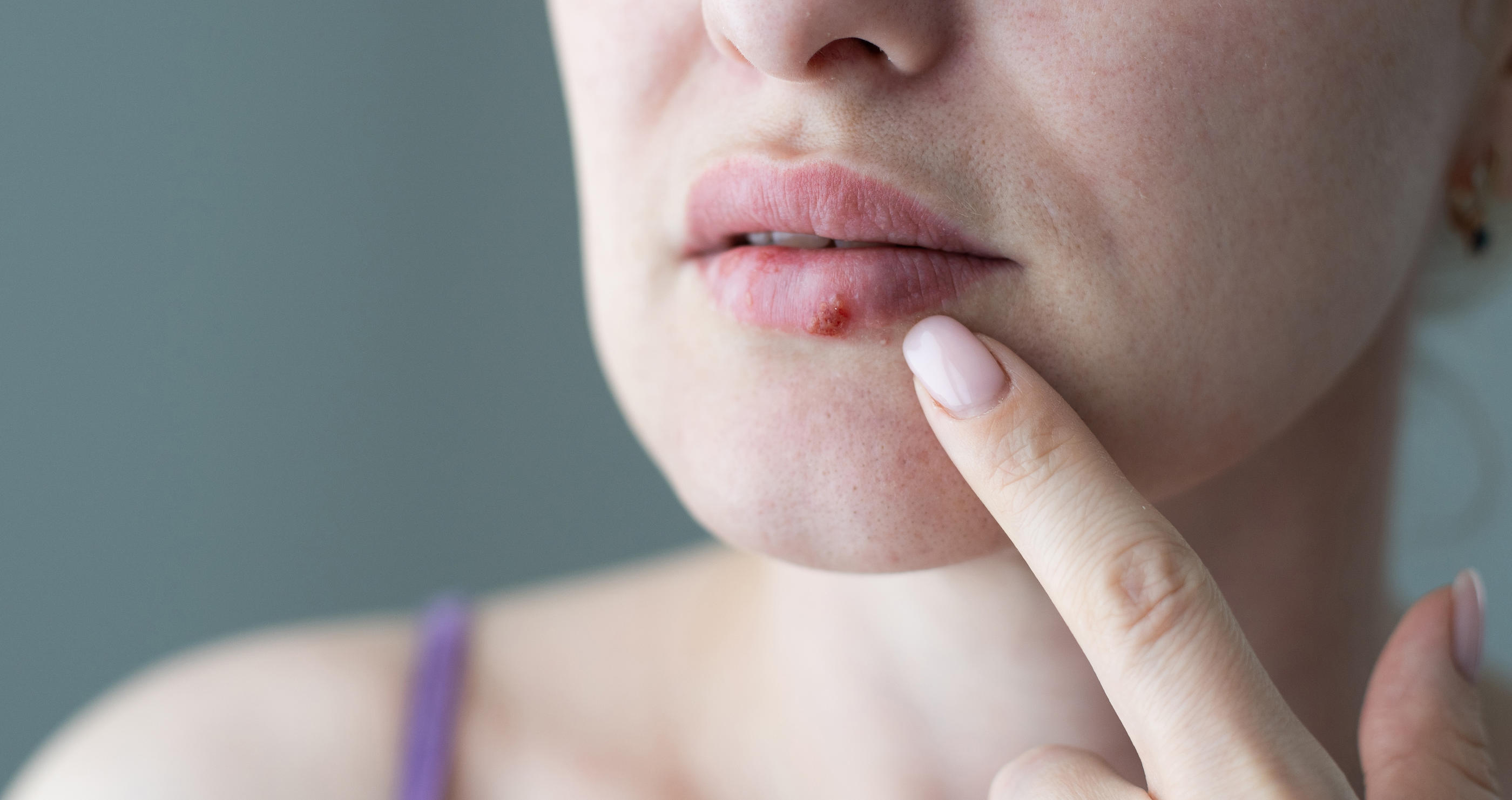 L’herpès labial s’annonce en général 48 heures avant l’apparition des lésions, par une sensation de chaleur et de tension au coin de la bouche ou sur la lèvre. Getty Images/iStockphoto/Sinenkiy