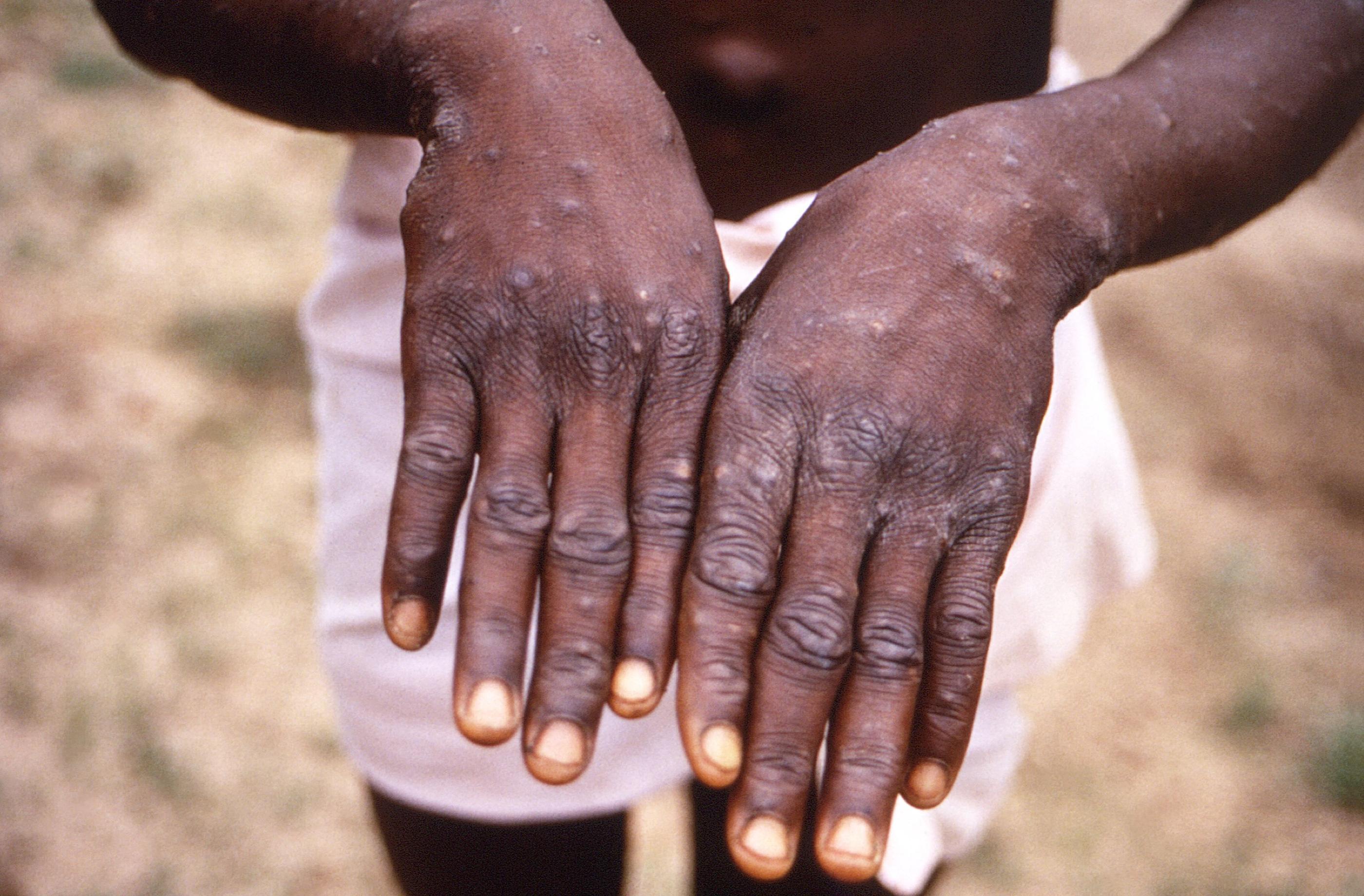 L'Organisation mondiale de la santé (OMS) avait déjà sonné l'alerte fin novembre sur cette épidémie en République démocratique du Congo (RDC). Brian W.J. Mahy / Centers for Disease Control and Prevention / AFP