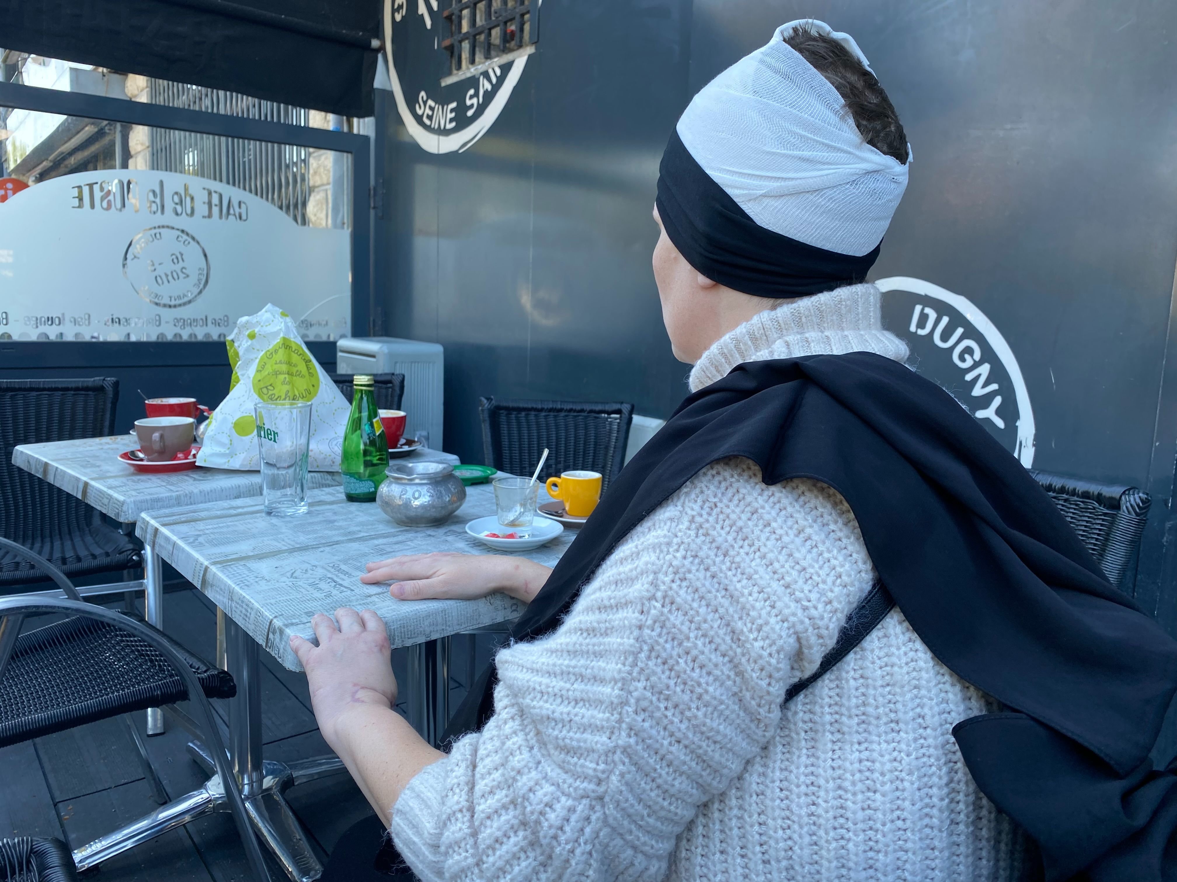 Dugny (Seine-Saint-Denis), dimanche 15 septembre. Après l'attaque, Lydia a dû subir une greffe au niveau du cuir chevelu, mais l'opération n'a pas bien marché. LP/Hélène Haus