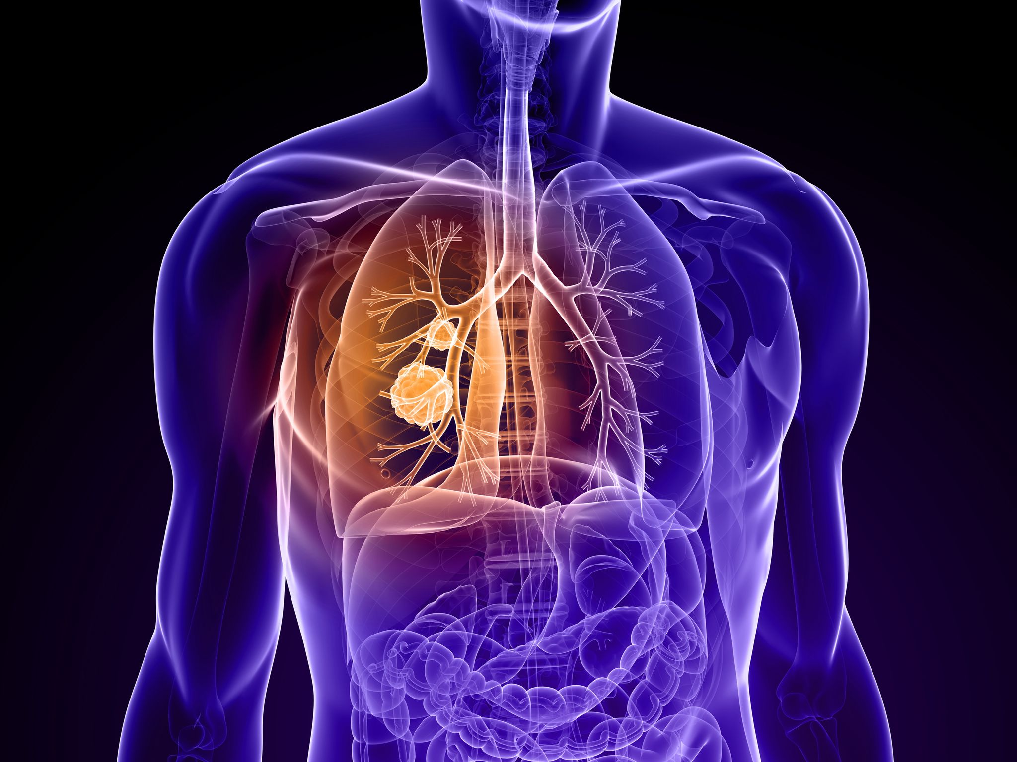 Cancer du poumon : Pour la première fois de l'Histoire, sa ...