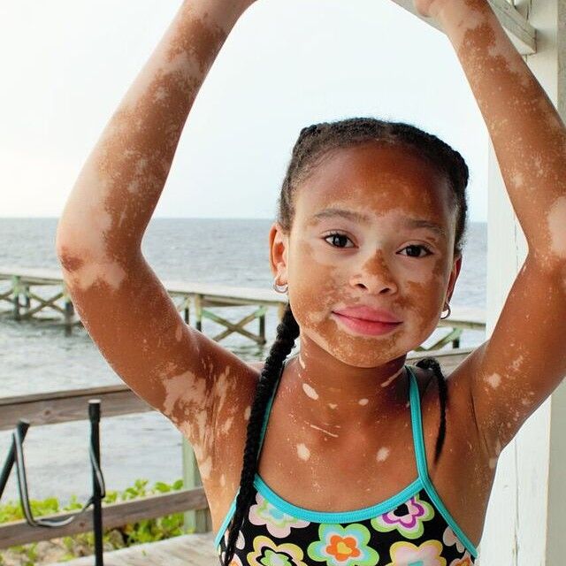 April Star, 10 ans, star d'Instagram atteinte de vitiligo – L'Express