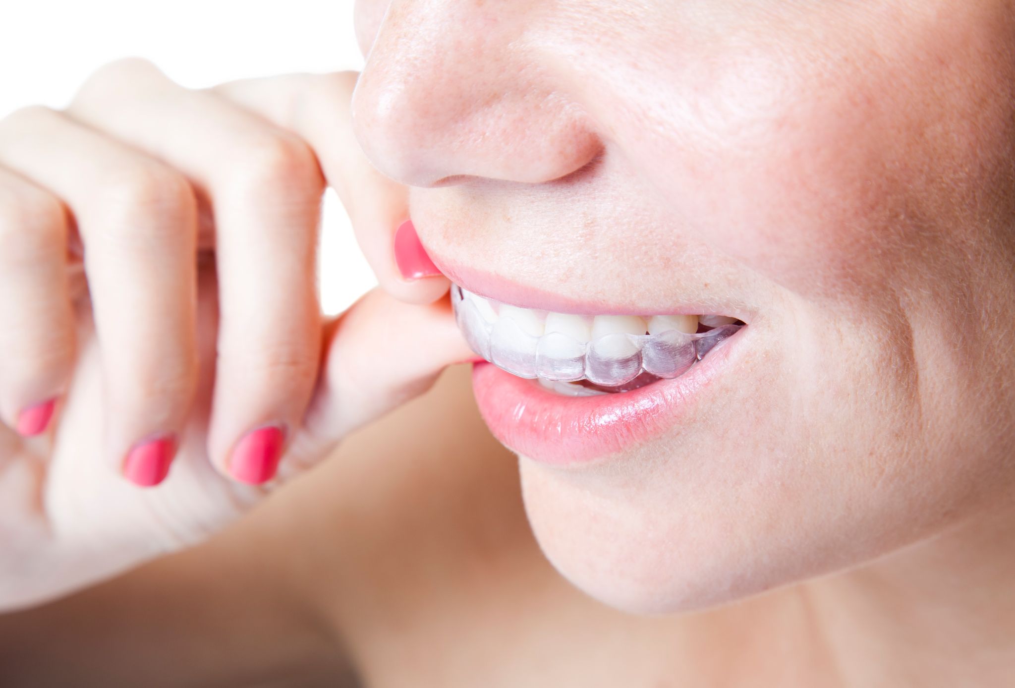 Appareil dentaire adulte invisible : quelles possibilités ? – L'Express