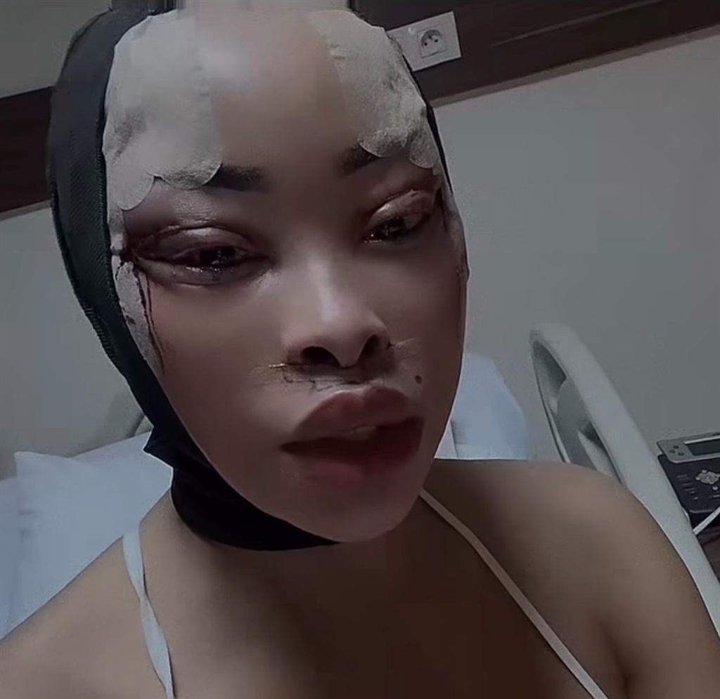 khanyi mbau skin lightening glutathione injections How Safe Is The Skin-Lightening