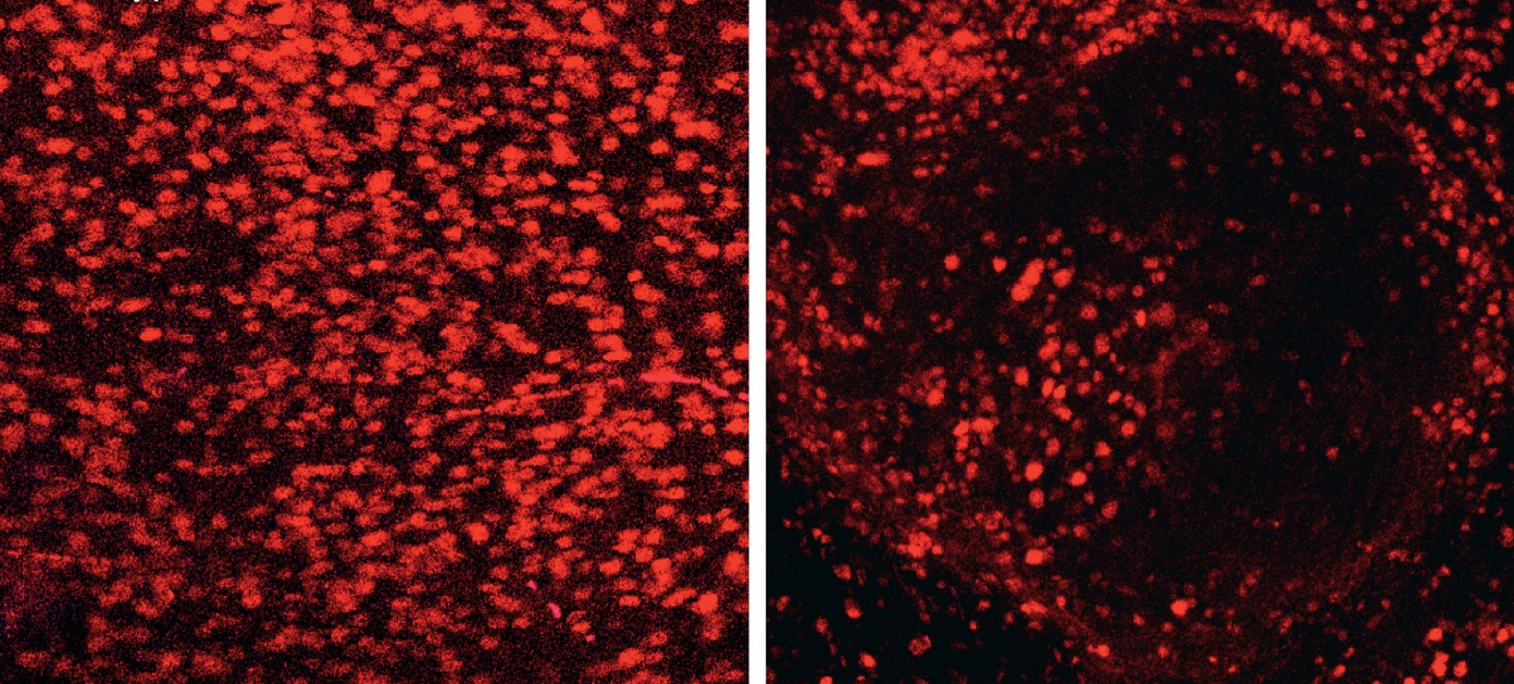 Neuronas de ratón (izquierda) y neuronas humanas degeneradas en el cerebro del ratón con síntomas de alzhéimer.