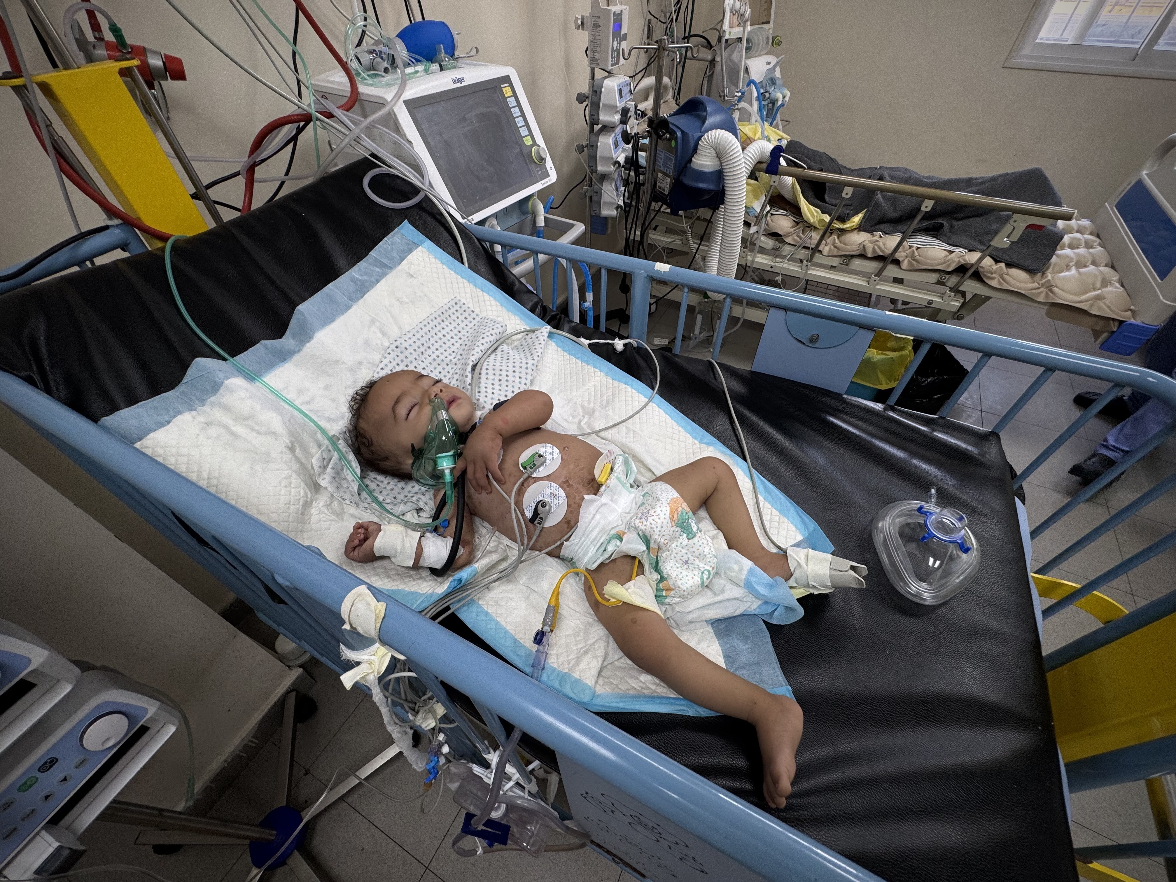 Un niño que sufre de desnutrición es tratado en el hospital Al Nasser, en Jan Yunis, al sur de la Franja, el pasado 20 de agosto de 2025.