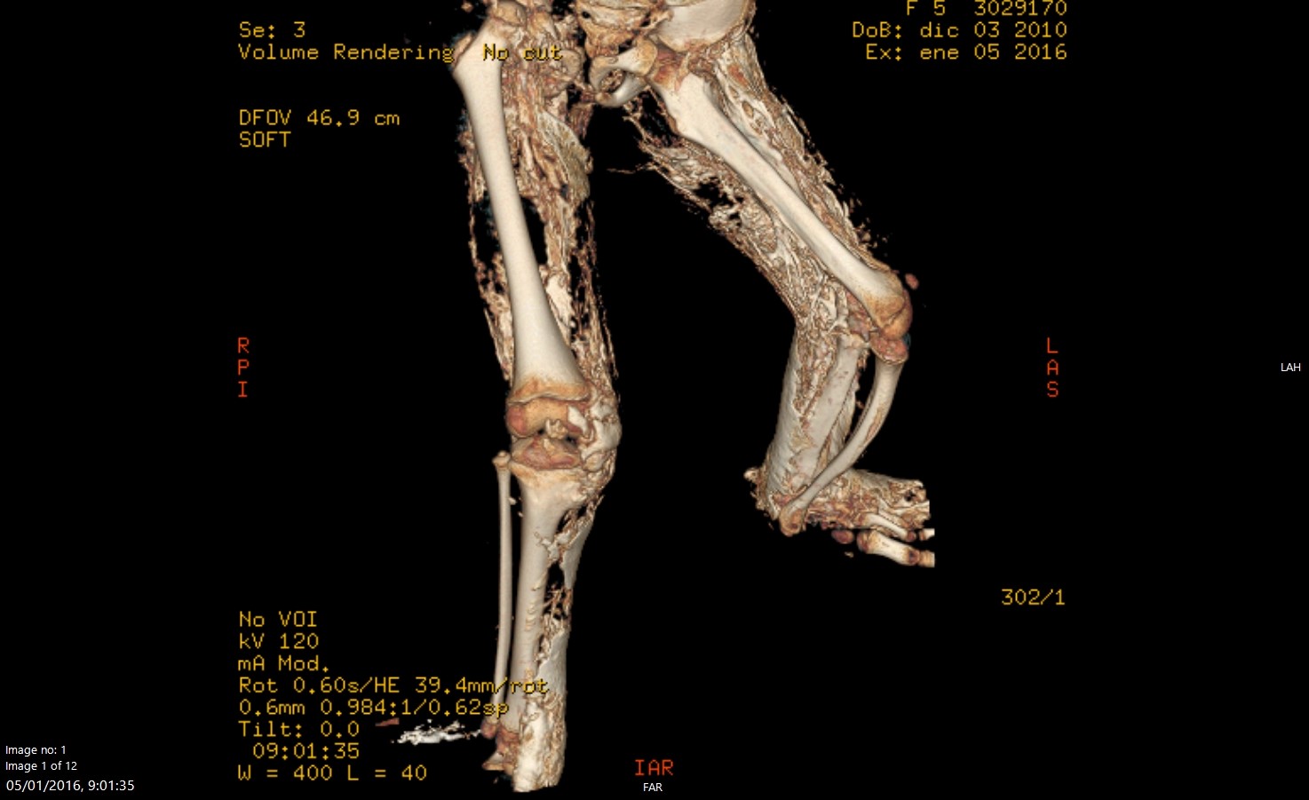 Escáner de las piernas de Cayetana en 2016, en el que se aprecia la transformación de músculo en hueso.