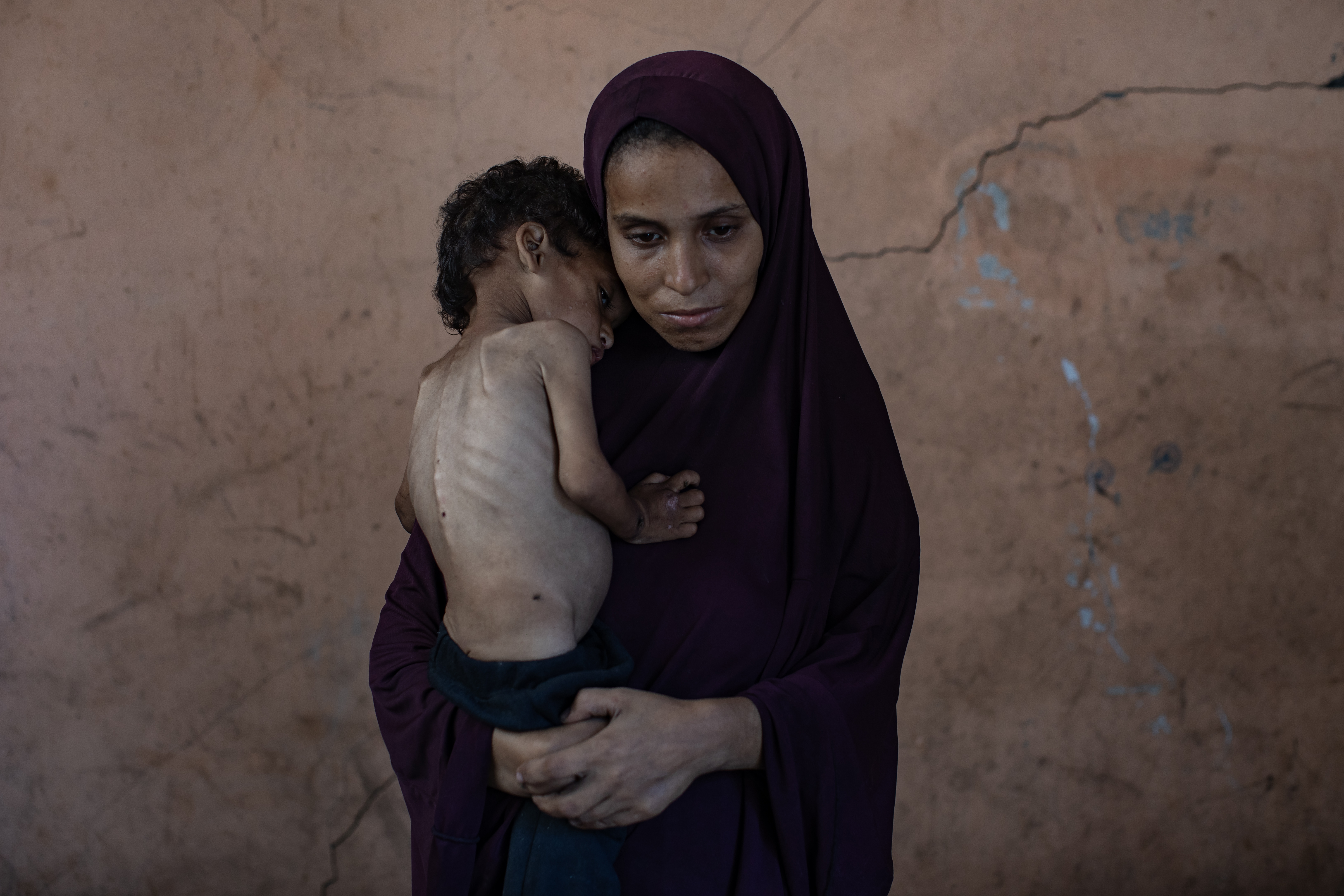 FOTODELDÍA. GAZA, 19/07/2025.- El niño palestino Yazan Abu Foul, que sufre de malnutrición, junto a su madre Naima, este sábado en el campo de refugiados Al Shati, al este de Gaza. Yazan crece en condiciones muy precarias de salud ya que su familia carece de las necesidades básicas en medio de una crisis humanitaria. Según fuentes médicas, la salud de los niños continúa deteriorándose por la falta de una alimentación apropiada y de una correcta atención sanitaria.Las asociaciones humanitarias han avisado de una inminente catástrofe alimentaria que amenaza la vida de miles de niños en la asediada Gaza, donde se produce un bloqueo de entrada de ayuda humanitaria y el cierre de fronteras por parte de Israel. EFE/HAITHAM IMAD