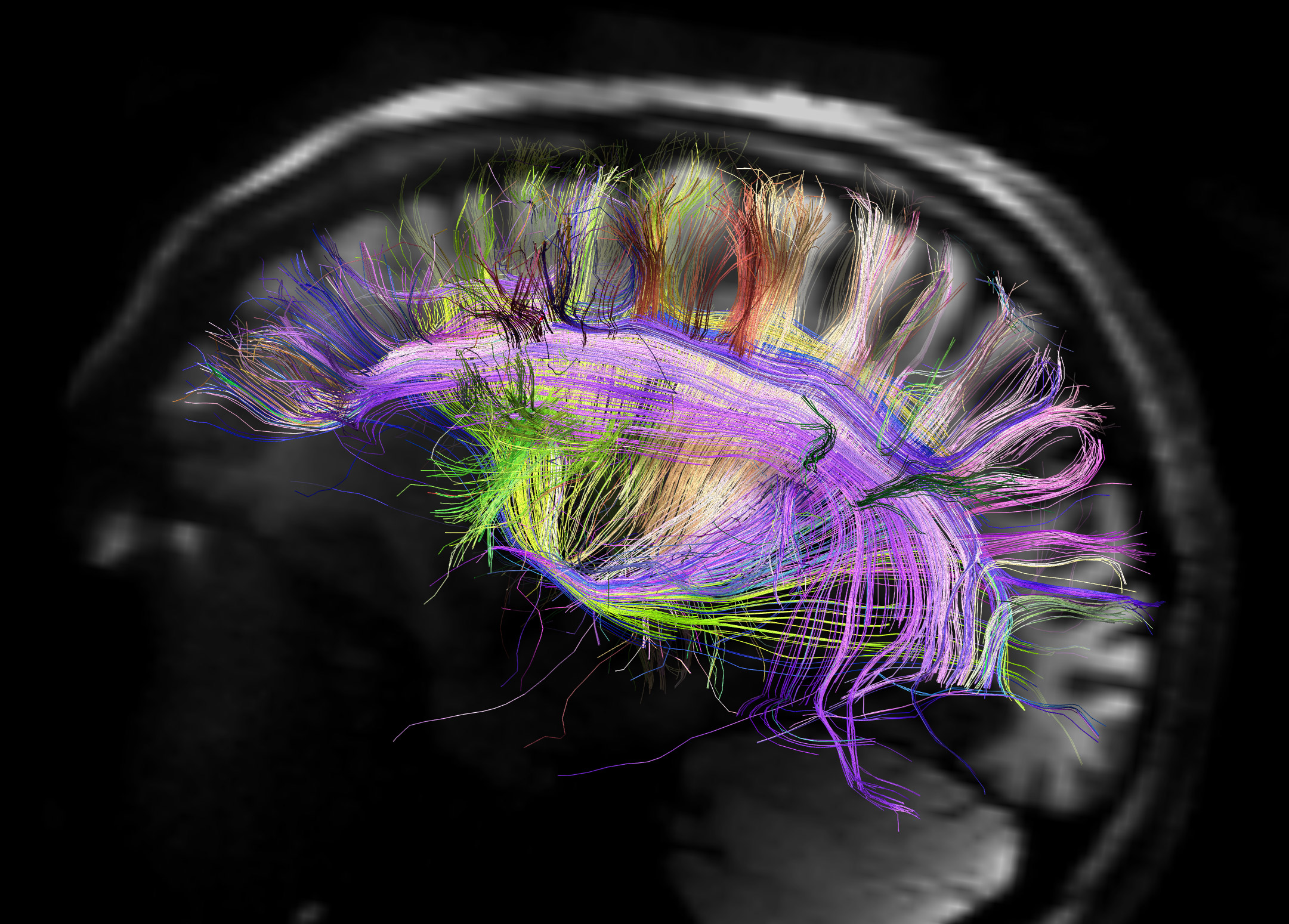 Imagen de resonancia magnética del cerebro humano que muestra las curvas de fibras neuronales.