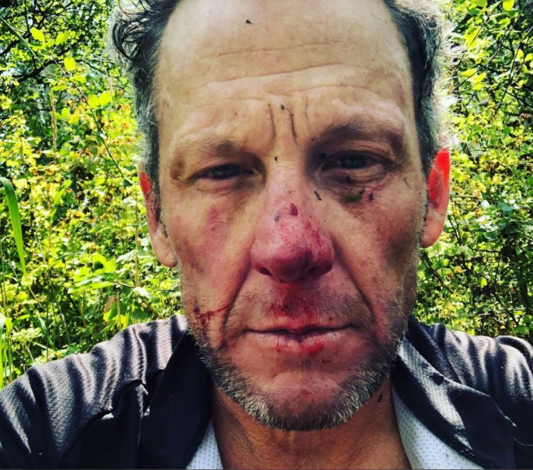 Armada partido Republicano tierra Armstrong publica en sus redes las heridas que sufrió después de una  aparatosa caída | Deportes | Cadena SER