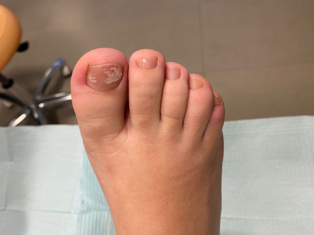estudio Objeción dictador Alerta podológica: Los esmaltes permanentes pueden causar hongos en las uñas  de los pies | Actualidad | Cadena SER