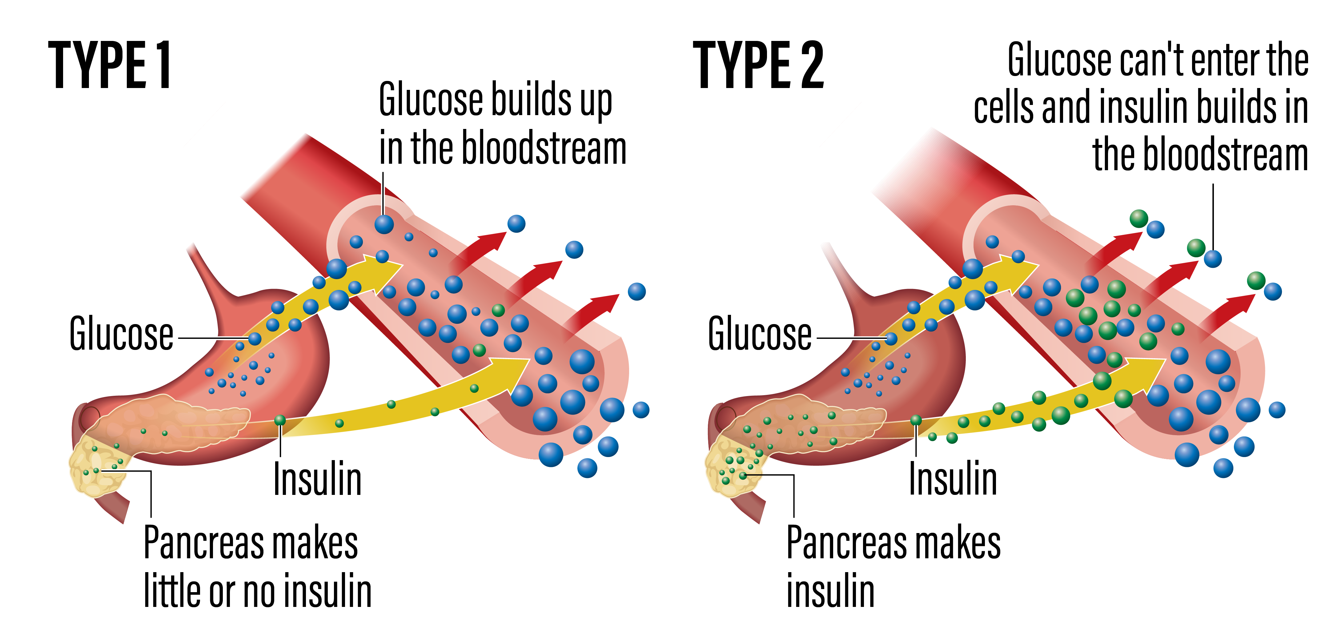 does semaglutide lower glucose What is semaglutide and how does it work? 💉 Semaglutide is a medication used in Type 2 Diabetes that can help lower blood glucose and support weight loss when prescribed and monitored does semaglutide lower glucose What is semaglutide and how does it work? 💉 Semaglutide is a medication used in Type 2 Diabetes that can help lower blood glucose and support weight loss when prescribed and monitored